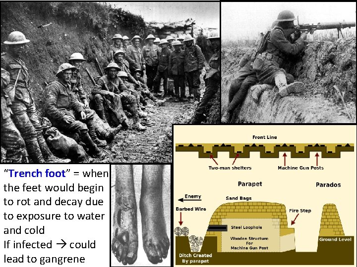 “Trench foot” = when the feet would begin to rot and decay due to