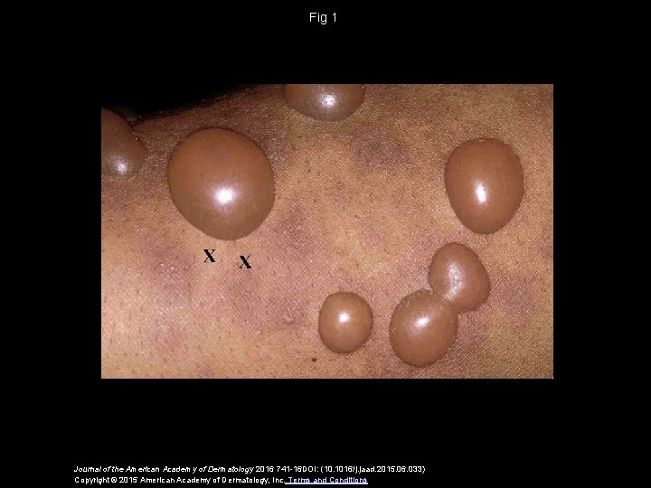 Fig 1 Journal of the American Academy of Dermatology 2016 741 -16 DOI: (10.