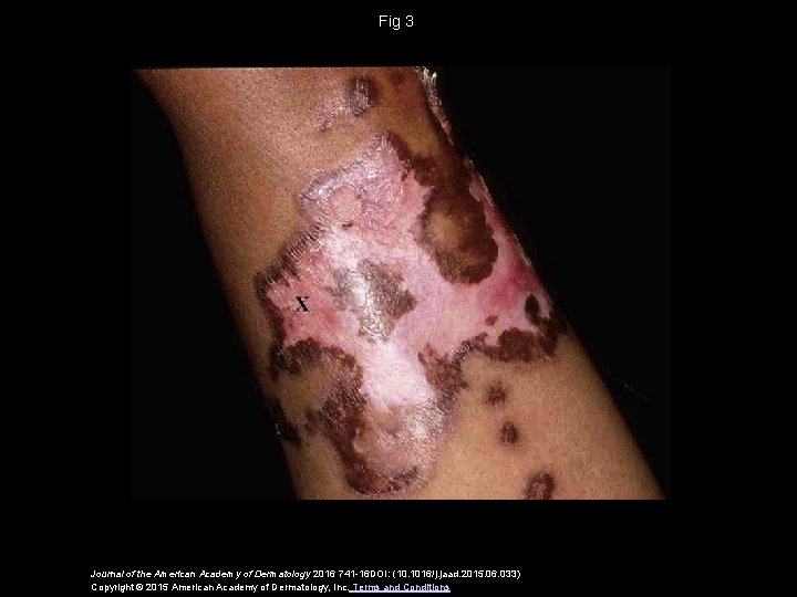 Fig 3 Journal of the American Academy of Dermatology 2016 741 -16 DOI: (10.