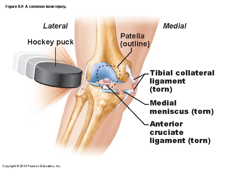 Figure 8. 9 A common knee injury. Lateral Hockey puck Medial Patella (outline) Tibial