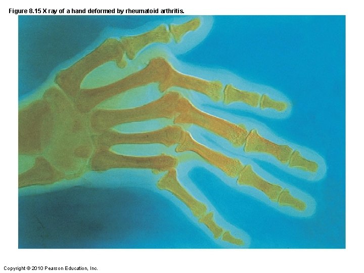 Figure 8. 15 X ray of a hand deformed by rheumatoid arthritis. Copyright ©