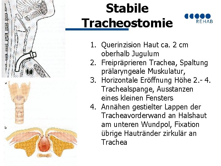 Stabile Tracheostomie 1. Querinzision Haut ca. 2 cm oberhalb Jugulum 2. Freipräprieren Trachea, Spaltung