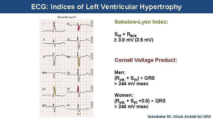 ECG: Indices of Left Ventricular Hypertrophy Sokolow-Lyon Index: SV 1 + RV 5/6 ≥