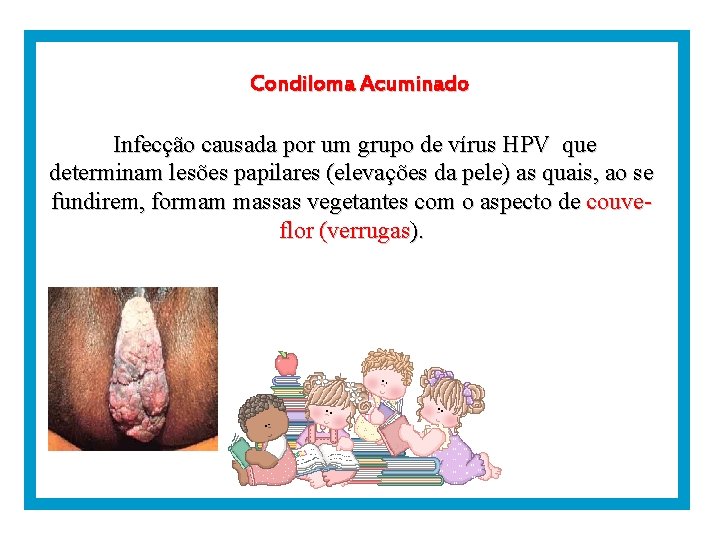 Condiloma Acuminado Infecção causada por um grupo de vírus HPV que determinam lesões papilares