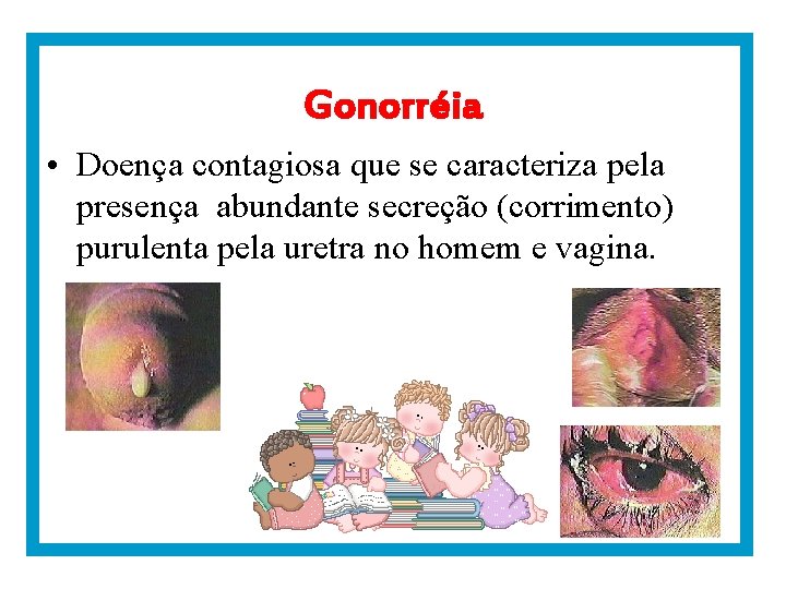 Gonorréia • Doença contagiosa que se caracteriza pela presença abundante secreção (corrimento) purulenta pela