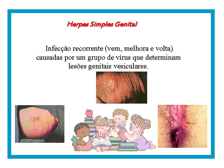 Herpes Simples Genital Infecção recorrente (vem, melhora e volta) causadas por um grupo de