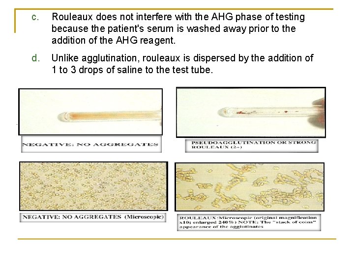 c. Rouleaux does not interfere with the AHG phase of testing because the patient's