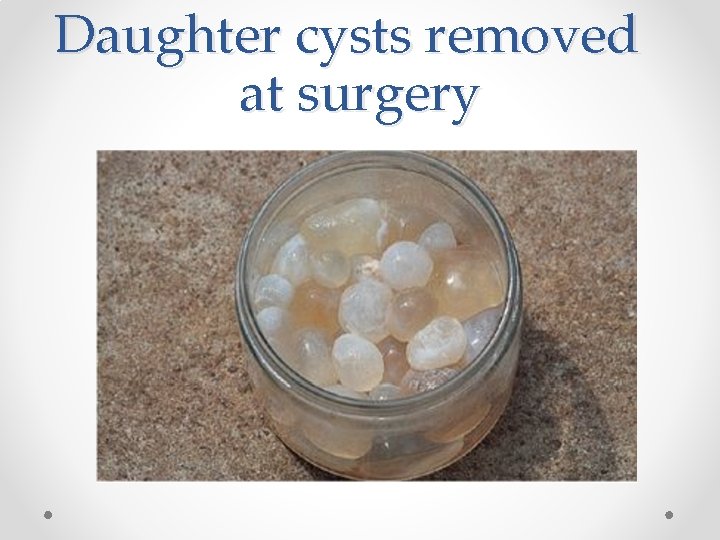 Daughter cysts removed at surgery 