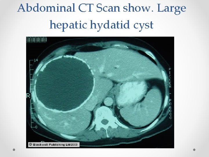 Abdominal CT Scan show. Large hepatic hydatid cyst 