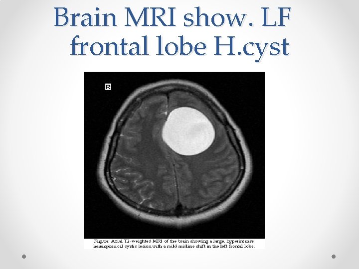 Brain MRI show. LF frontal lobe H. cyst 