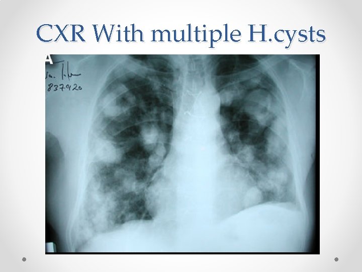 CXR With multiple H. cysts 