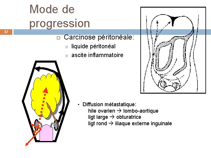 Mode de progression 32 Carcinose péritonéale: liquide péritonéal ascite inflammatoire • Diffusion métastatique: hile
