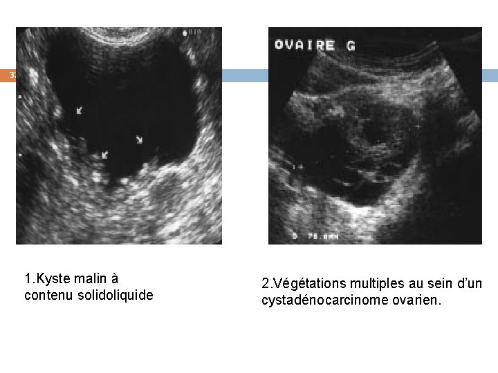 37 1. Kyste malin à contenu solidoliquide 2. Végétations multiples au sein d’un cystadénocarcinome