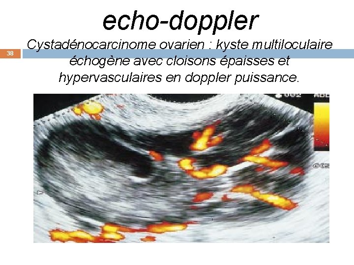 echo-doppler 38 Cystadénocarcinome ovarien : kyste multiloculaire échogène avec cloisons épaisses et hypervasculaires en