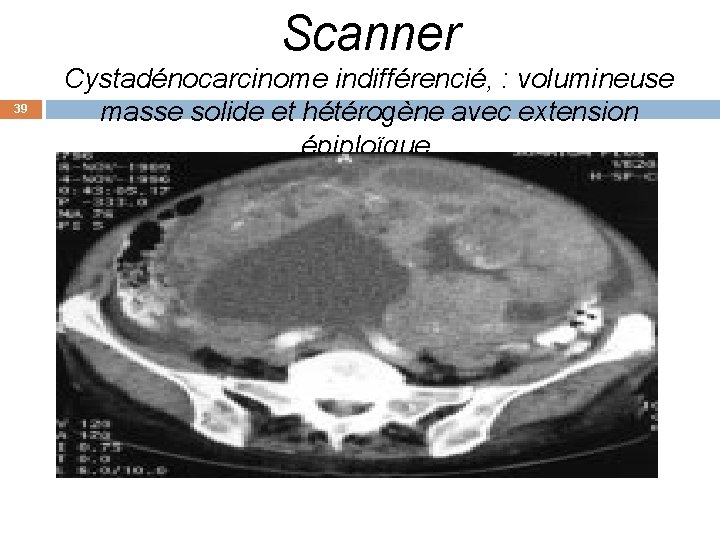 Scanner 39 Cystadénocarcinome indifférencié, : volumineuse masse solide et hétérogène avec extension épiploïque. 