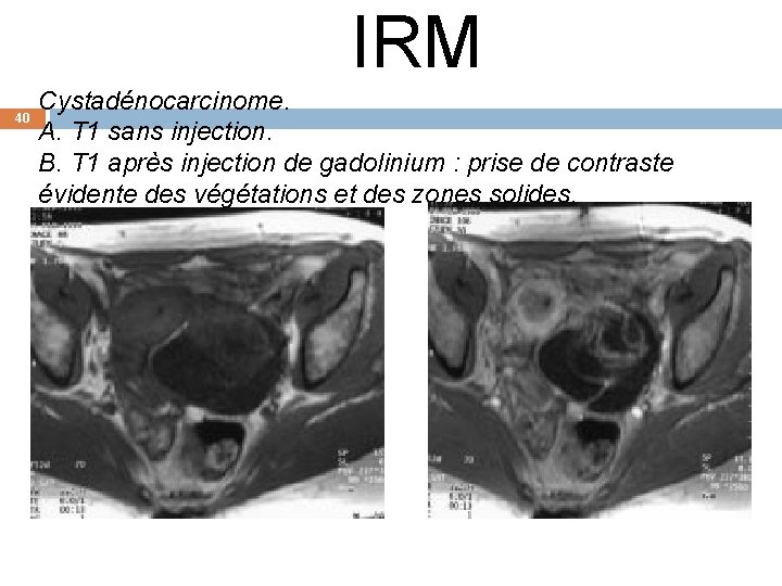 IRM 40 Cystadénocarcinome. A. T 1 sans injection. B. T 1 après injection de