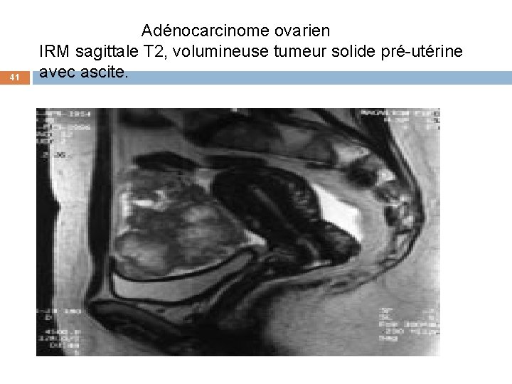 41 Adénocarcinome ovarien IRM sagittale T 2, volumineuse tumeur solide pré-utérine avec ascite. 