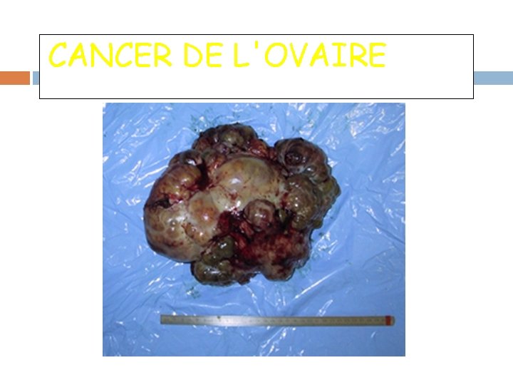 CANCER DE L'OVAIRE 