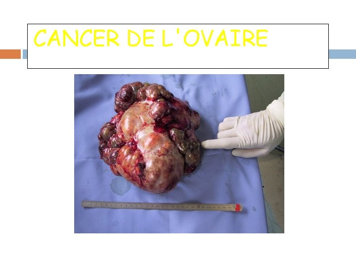 CANCER DE L'OVAIRE 