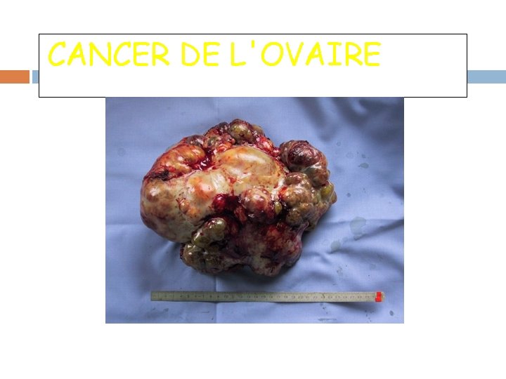 CANCER DE L'OVAIRE 