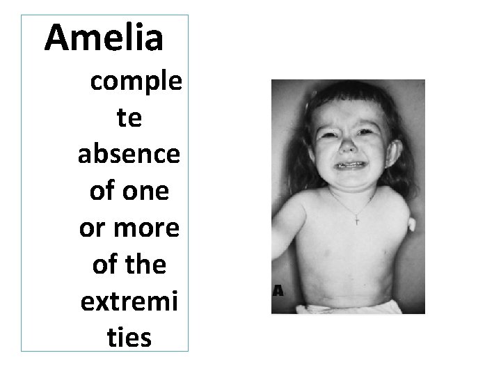 Amelia comple te absence of one or more of the extremi ties 