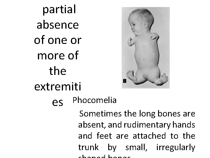 partial absence of one or more of the extremiti es Phocomelia Sometimes the long