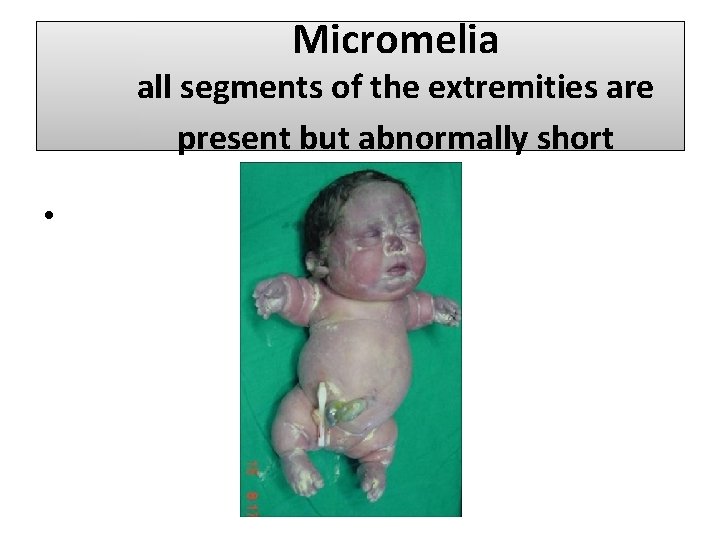 Micromelia all segments of the extremities are present but abnormally short • 