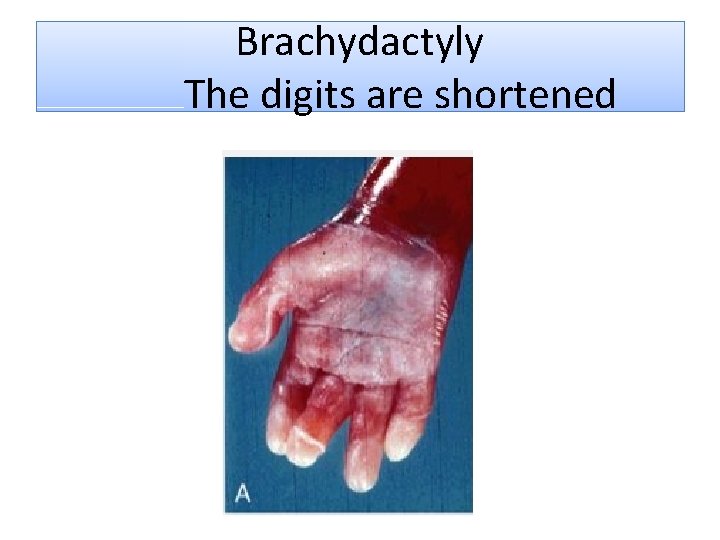 Brachydactyly The digits are shortened 