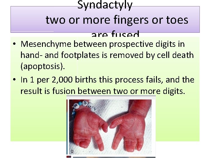Syndactyly two or more fingers or toes are fused • Mesenchyme between prospective digits