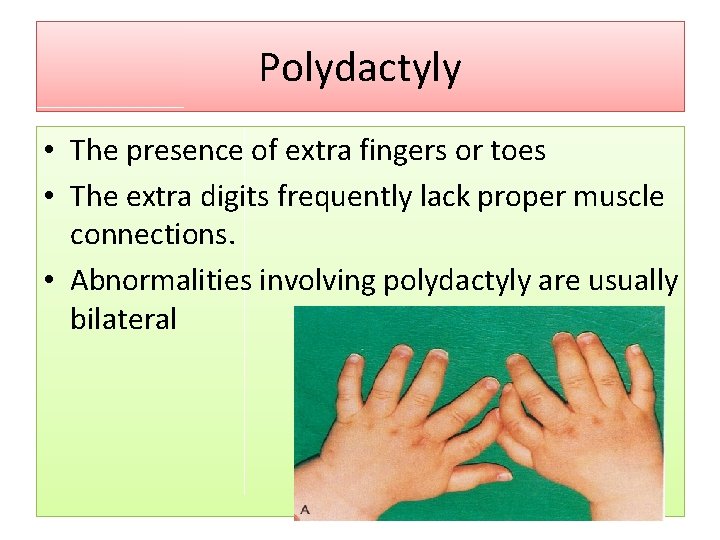 Polydactyly • The presence of extra fingers or toes • The extra digits frequently