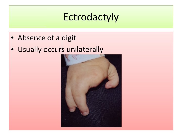 Ectrodactyly • Absence of a digit • Usually occurs unilaterally 