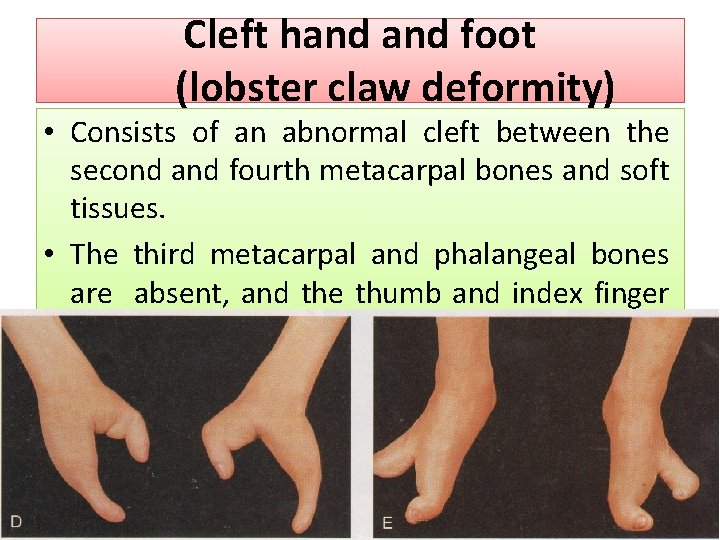 Cleft hand foot (lobster claw deformity) • Consists of an abnormal cleft between the