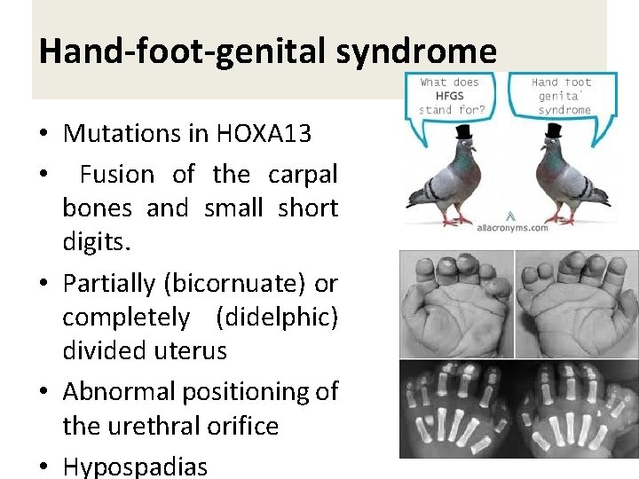 Hand-foot-genital syndrome • Mutations in HOXA 13 • Fusion of the carpal bones and
