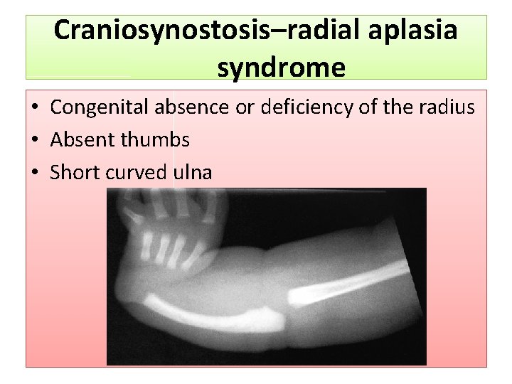 Craniosynostosis–radial aplasia syndrome • Congenital absence or deficiency of the radius • Absent thumbs
