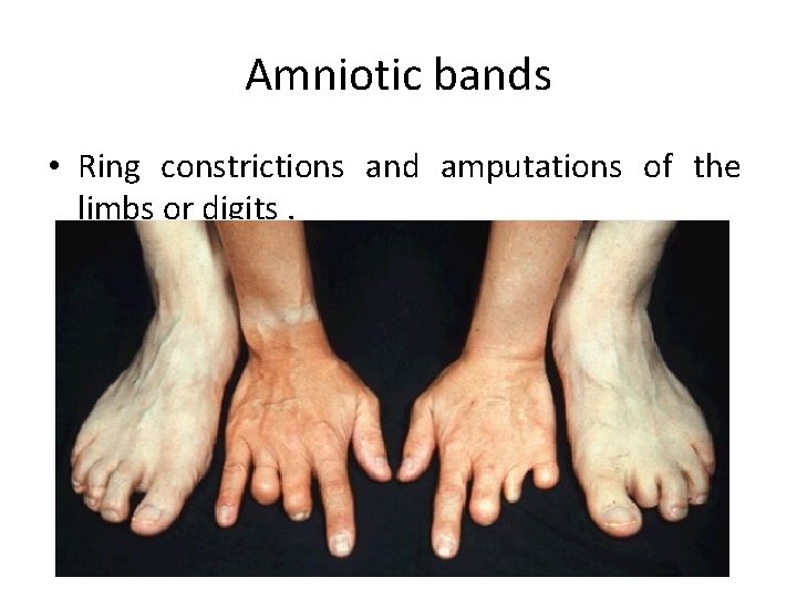 Amniotic bands • Ring constrictions and amputations of the limbs or digits. 