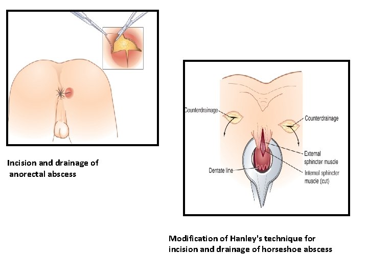 Incision and drainage of anorectal abscess Modification of Hanley's technique for incision and drainage