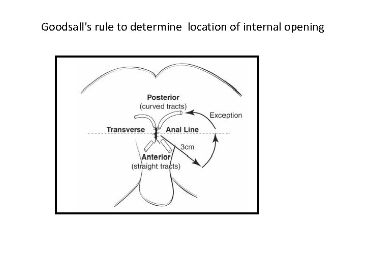 Goodsall's rule to determine location of internal opening 