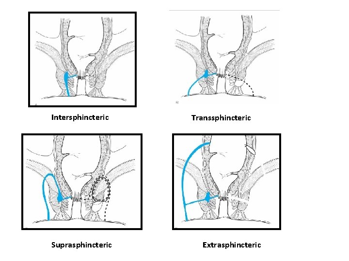 Intersphincteric Suprasphincteric Transsphincteric Extrasphincteric 