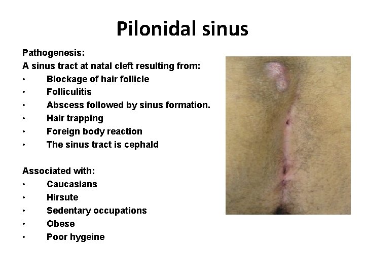 Pilonidal sinus Pathogenesis: A sinus tract at natal cleft resulting from: • Blockage of