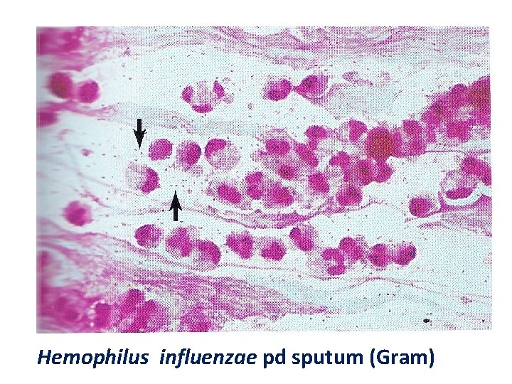 Hemophilus influenzae pd sputum (Gram) 