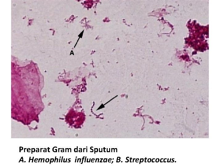 A Preparat Gram dari Sputum A. Hemophilus influenzae; B. Streptococcus. 