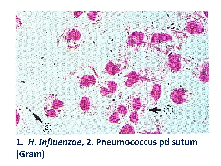 1. H. Influenzae, 2. Pneumococcus pd sutum (Gram) 