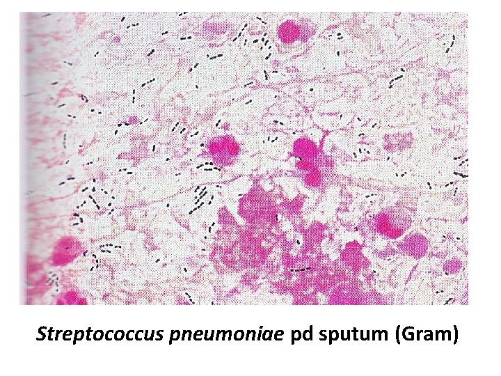 Streptococcus pneumoniae pd sputum (Gram) 