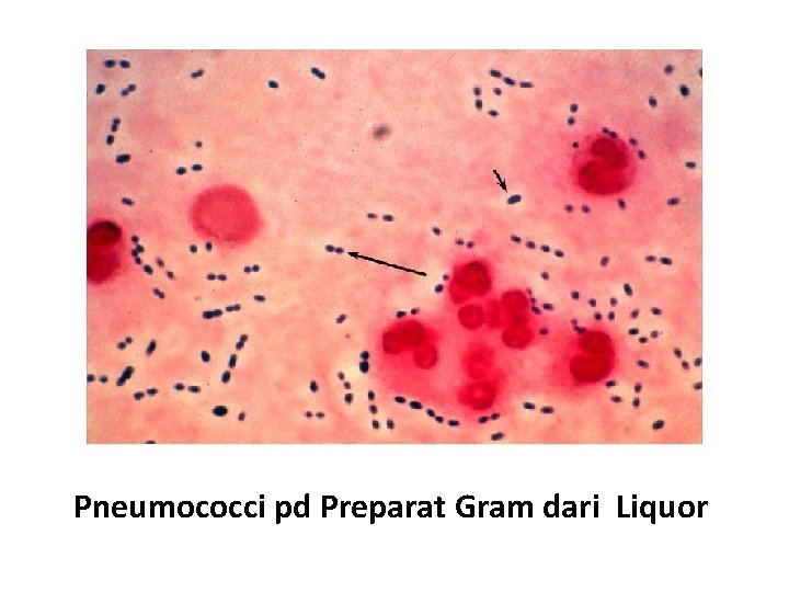 Pneumococci pd Preparat Gram dari Liquor 