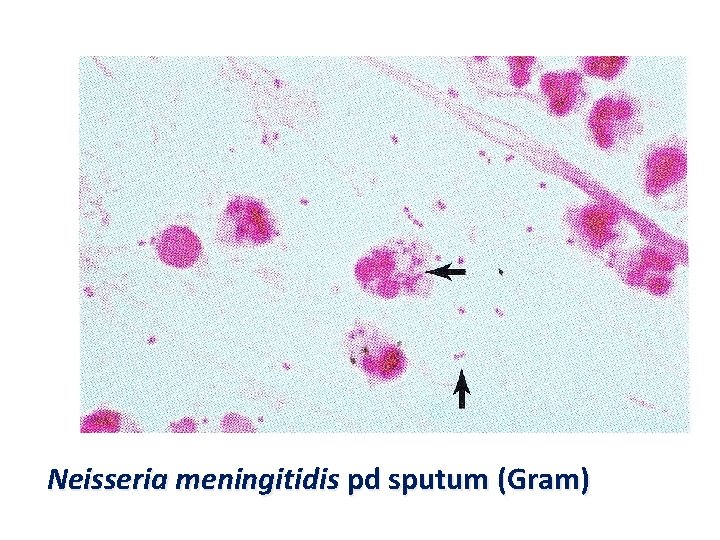 Neisseria meningitidis pd sputum (Gram) 