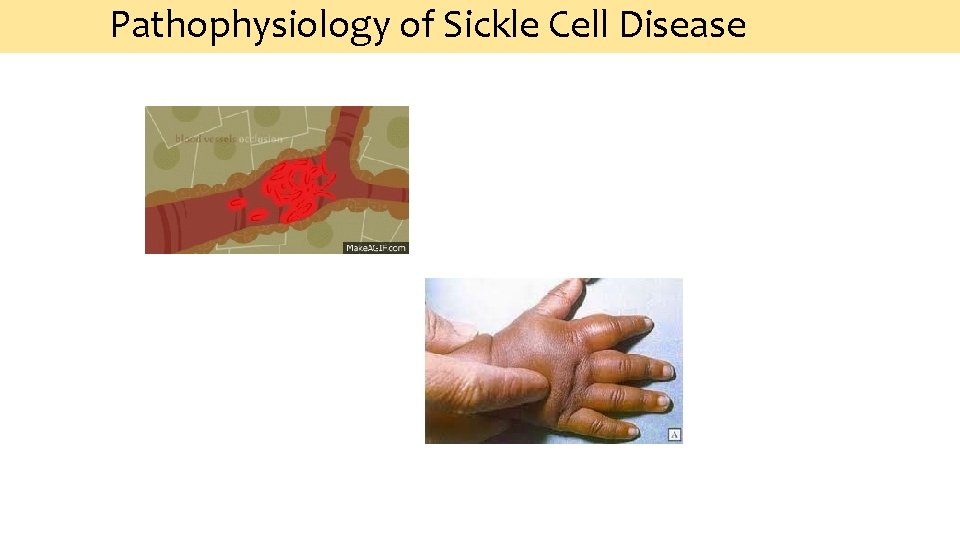 Pathophysiology of Sickle Cell Disease 