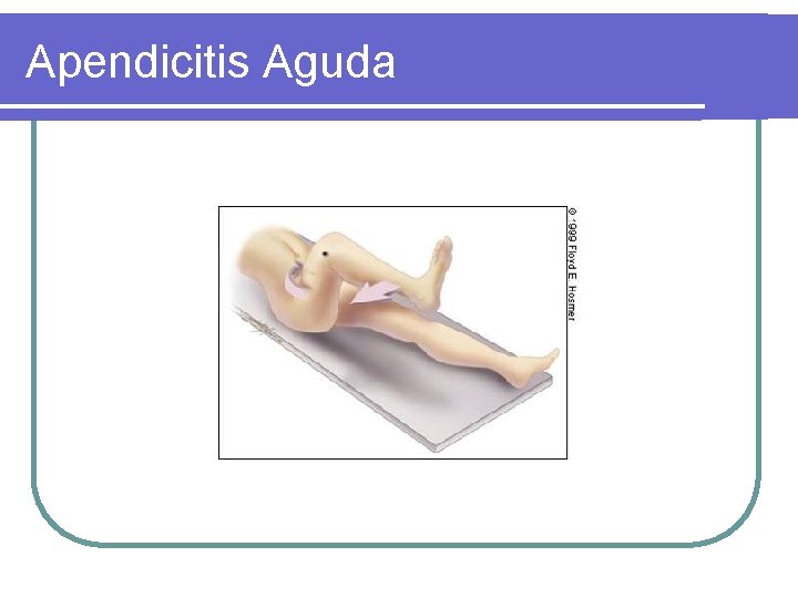 Apendicitis Aguda 