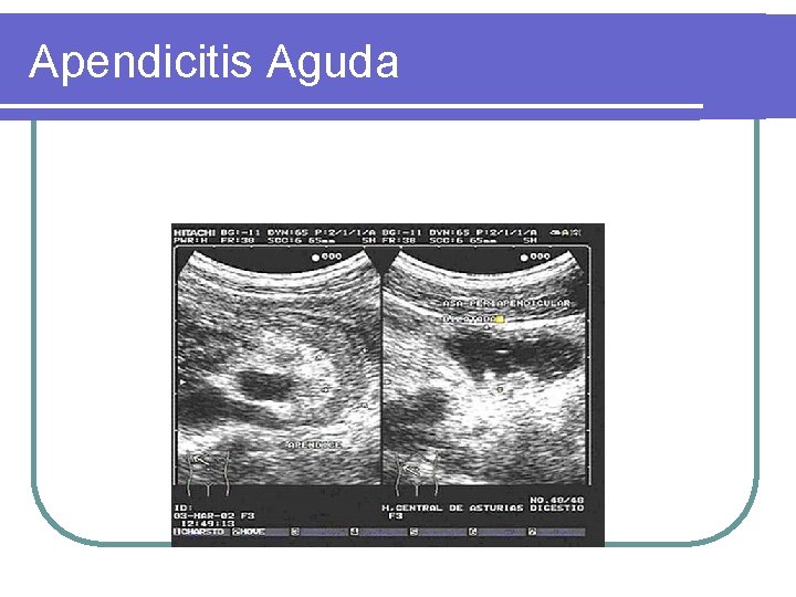 Apendicitis Aguda 