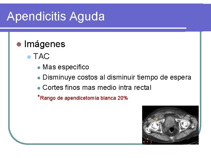 Apendicitis Aguda l Imágenes l TAC Mas especifico l Disminuye costos al disminuir tiempo