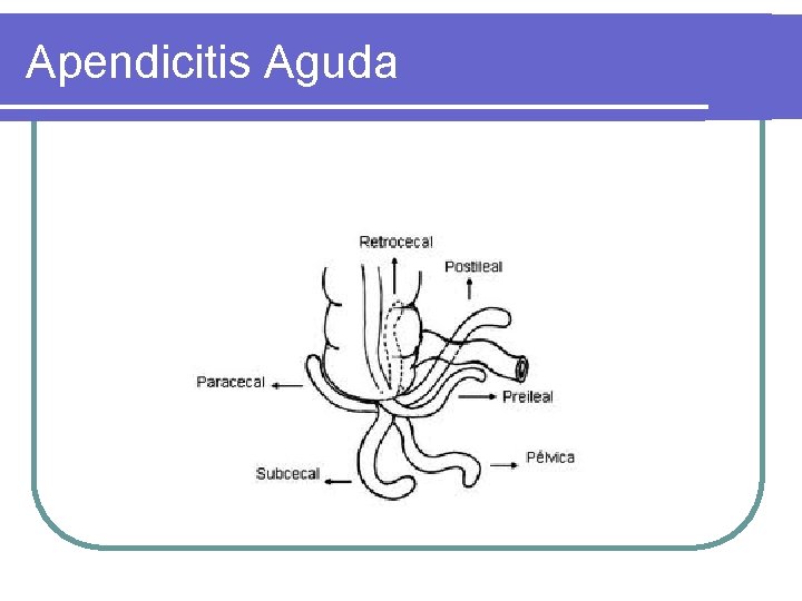 Apendicitis Aguda 